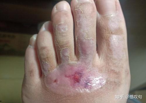 烫伤换药视频,视频教学,轻松掌握护理技巧